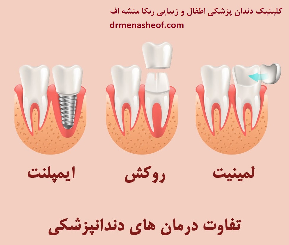 تفاوت ایمپلنت و لمینت دندان