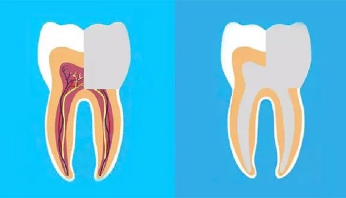 پالپتومی و پالپکتومی