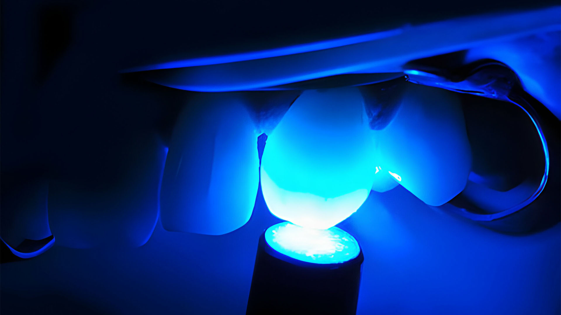 کامپوزیت بهتر است یا لمینت؟