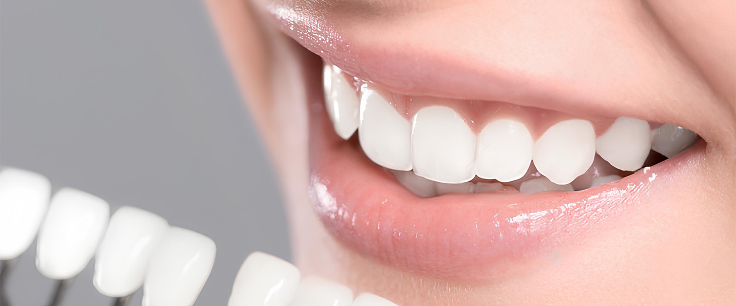 لمینت های سرامیکی یا پرسلن ونیر معمولا چند سال دوام می آورند؟