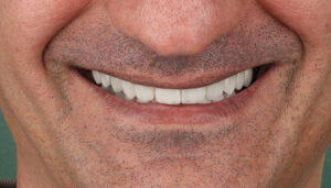 بازسازی لبخند با لمینت و ایمپلنت