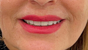 درمان سایش دندان با لمینت