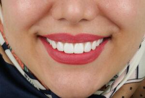 لیزر لثه قبل از لمینت دندان