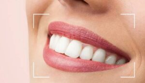 اصلاح طرح لبخند